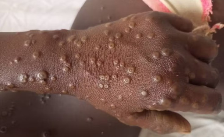 Extensive Mpox Monitoring Launched as Infected Driver Returns to Kenya